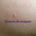 Hoy toca médico: ¡me ha picado un bicho!